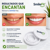 SmileFit™ CARILLAS DENTALES REMOVIBLES